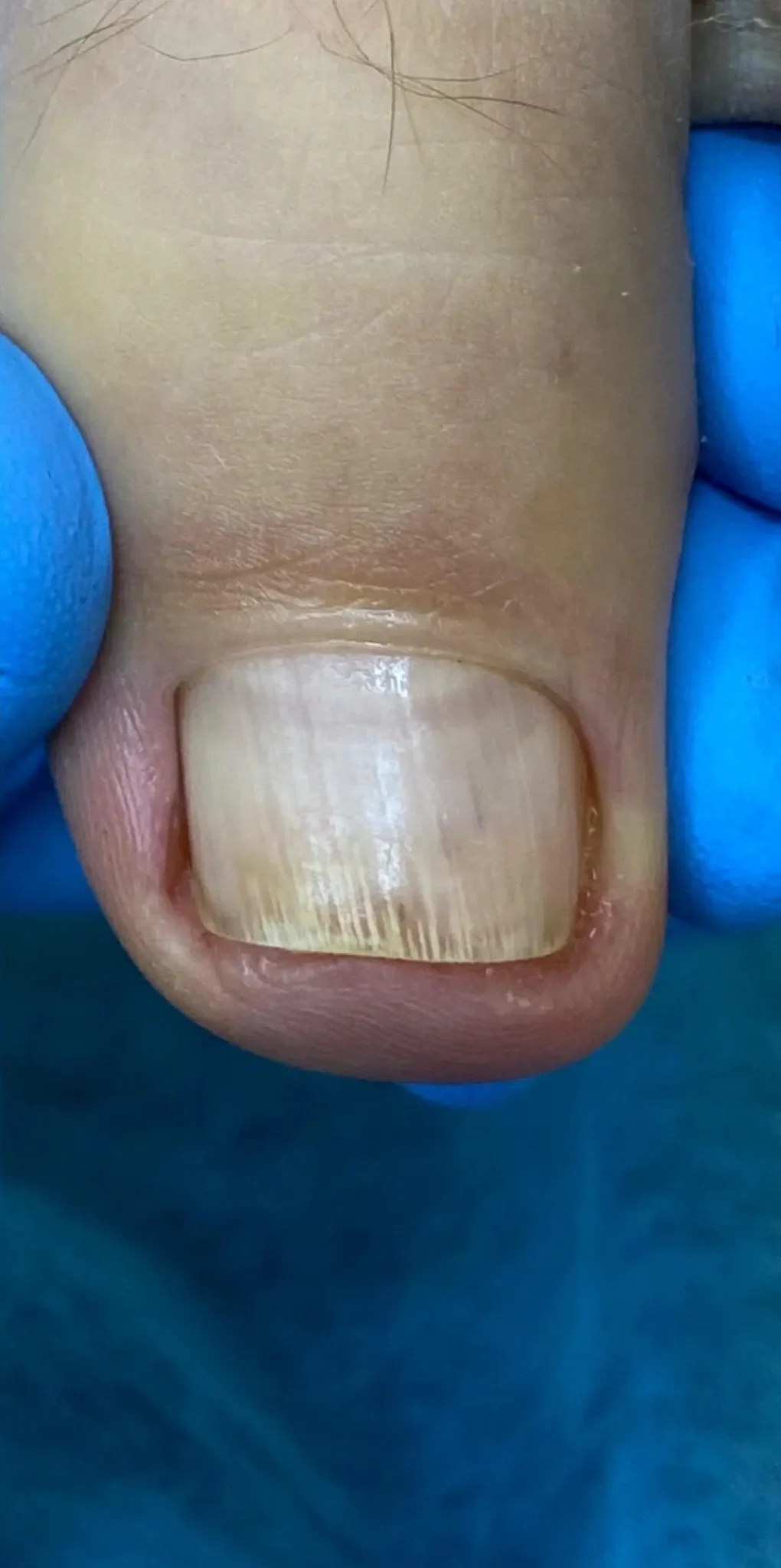 leczenie paznokcia grzybiczego po zabiegu