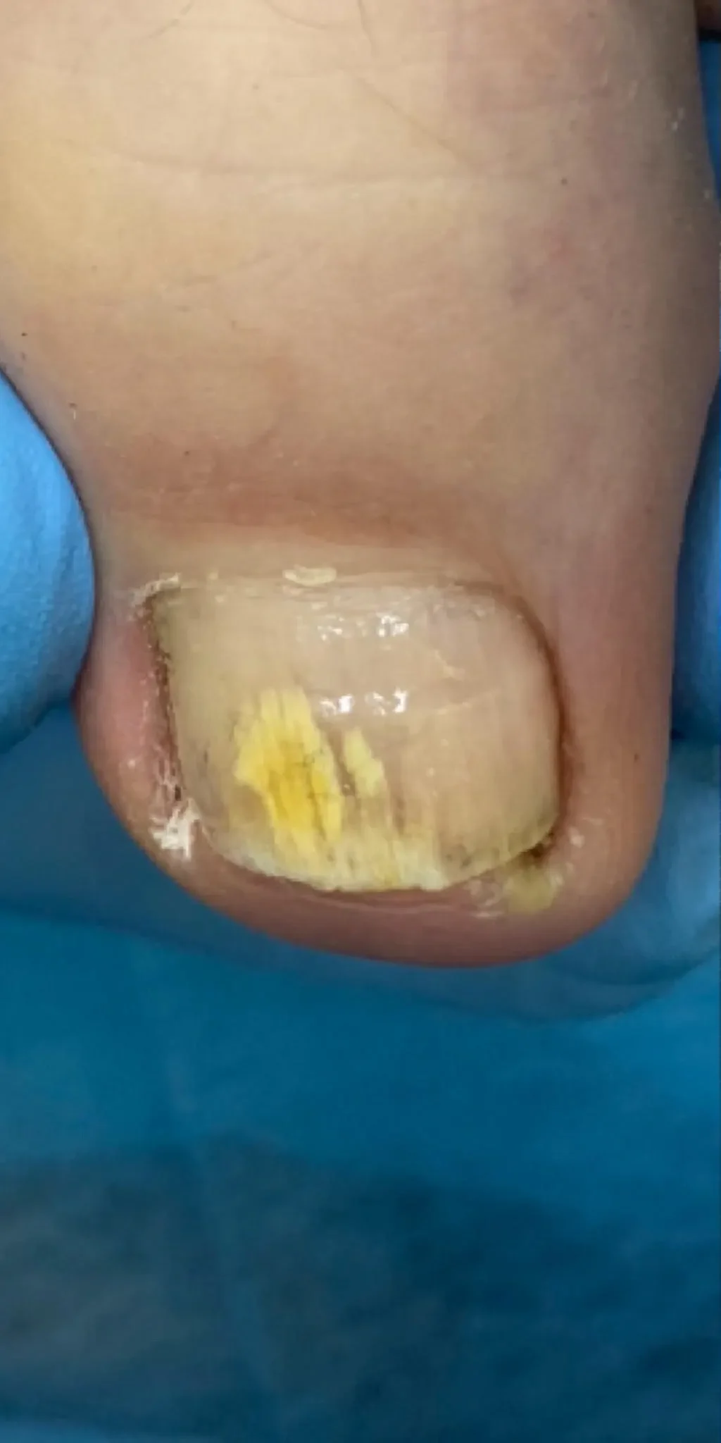 leczenie paznokcia grzybiczego przed zabiegiem