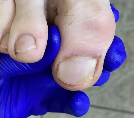 terapia paznokcia grzybiczego po zabiegu