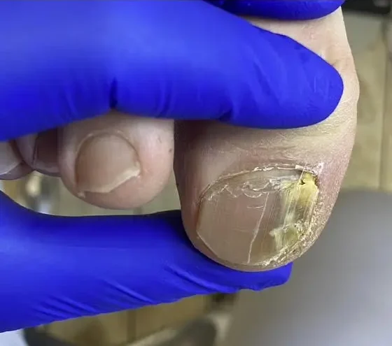 terapia paznokcia grzybiczego przed zabiegiem