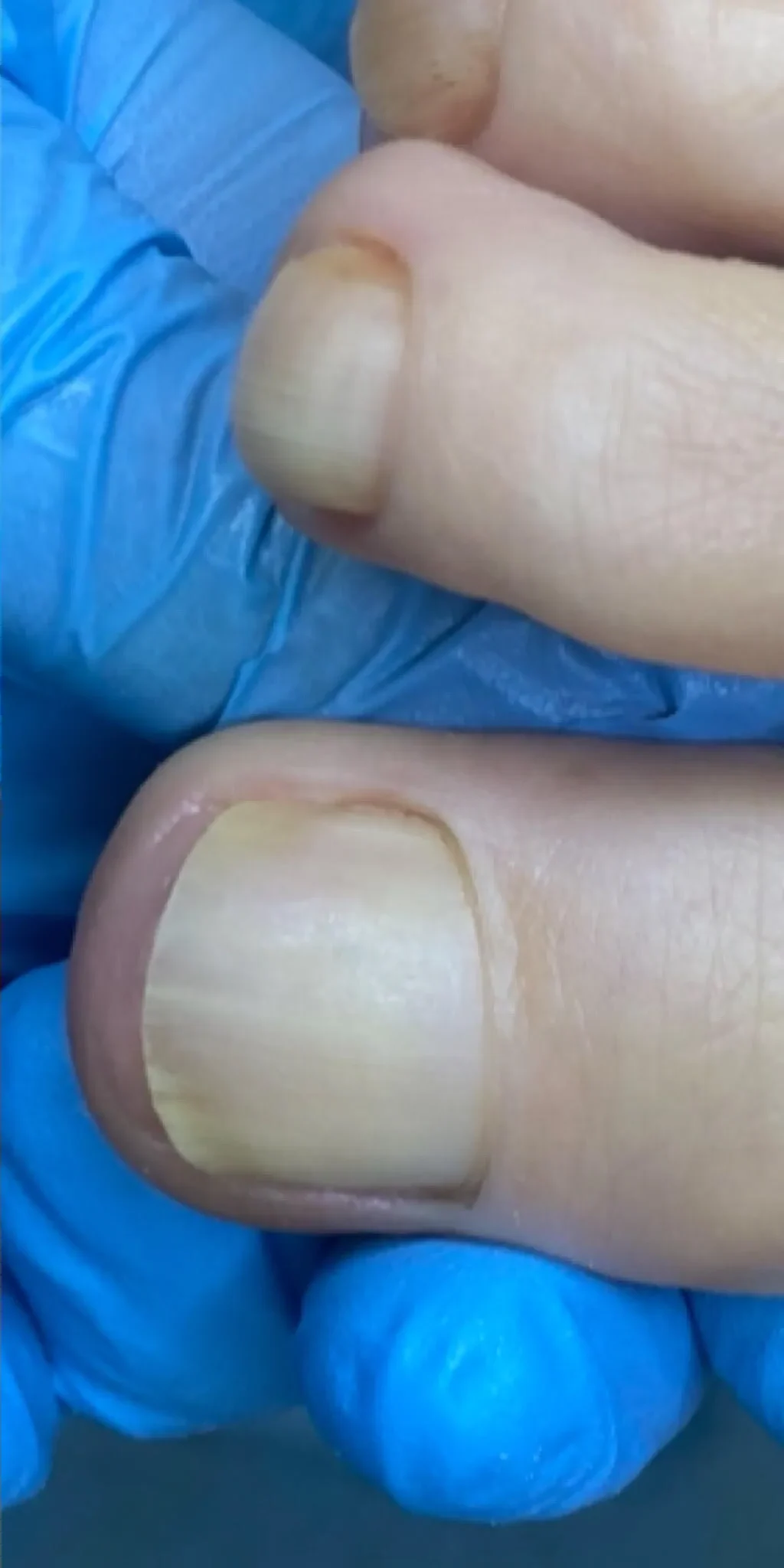 grzybica paznokci leczenie po zabiegu