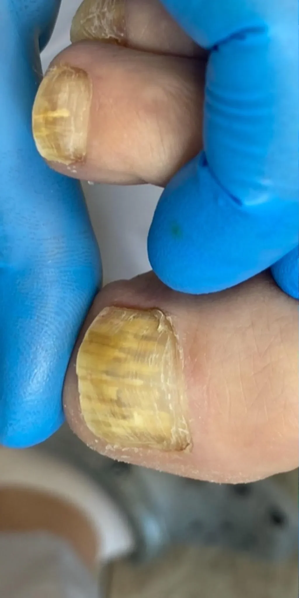 grzybica paznokci leczenie przed zabiegiem