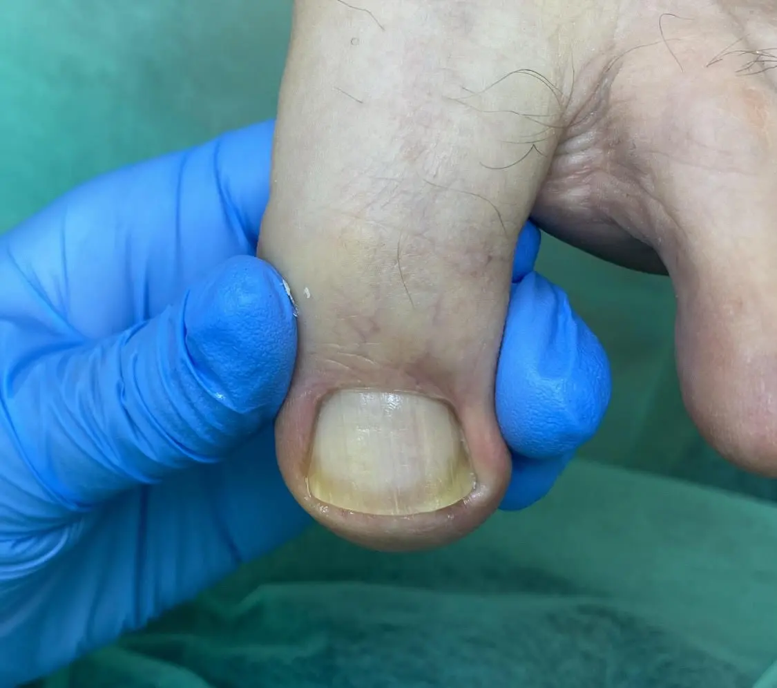 leczenie grzybicy paznokci po zabiegu