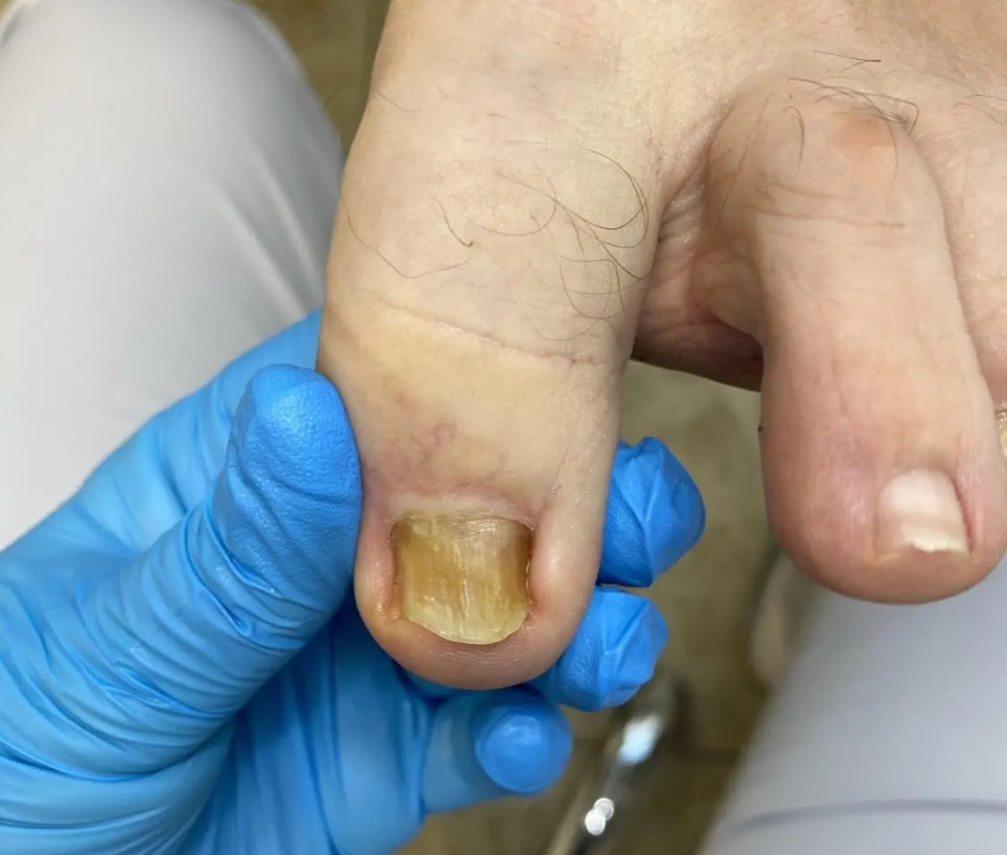 leczenie grzybicy paznokci przed zabiegiem