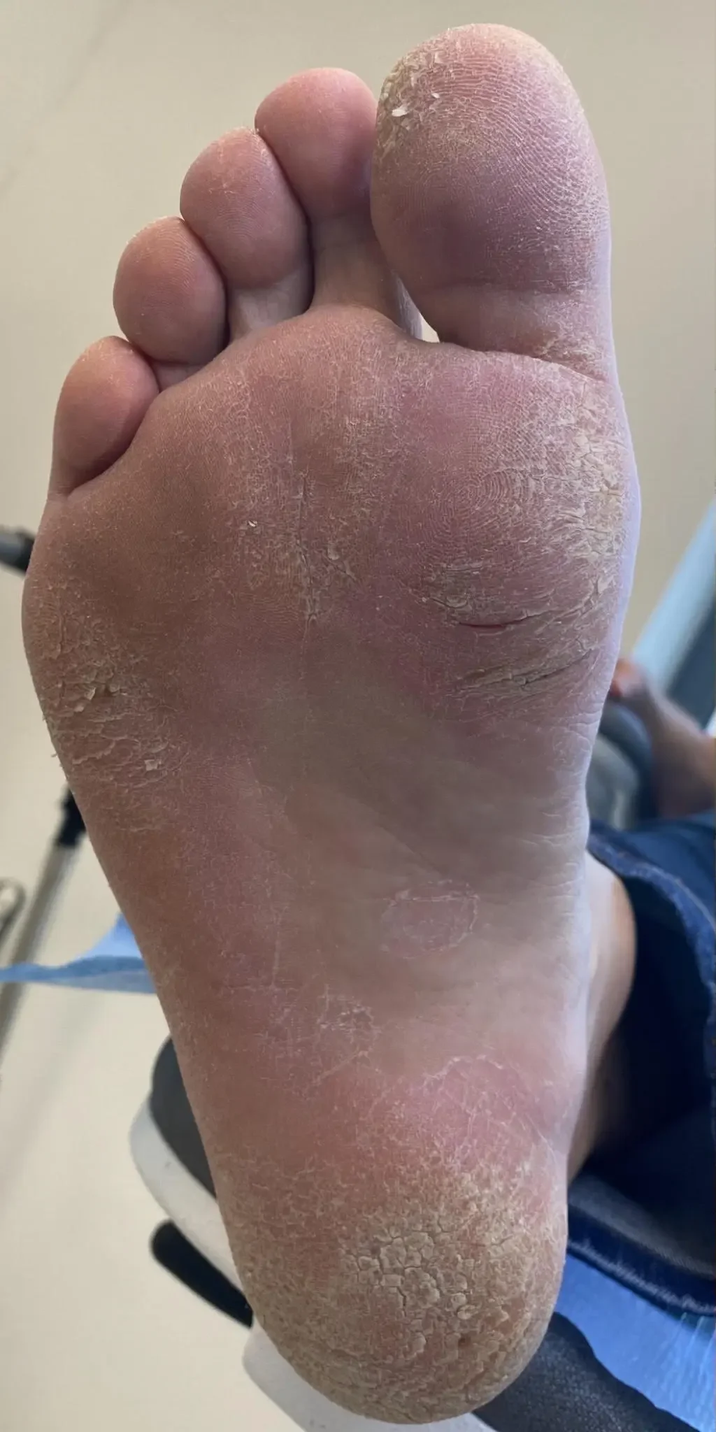 pedicure podologiczny przed zabiegiem